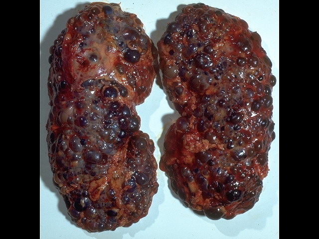 A Diseased Kidney