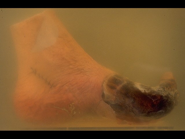 Gangrene of foot