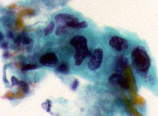 SCC_lung_cytology.jpg (25401 bytes)