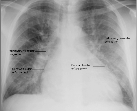 pulmonary_oedema_CXR.gif (118109 bytes)