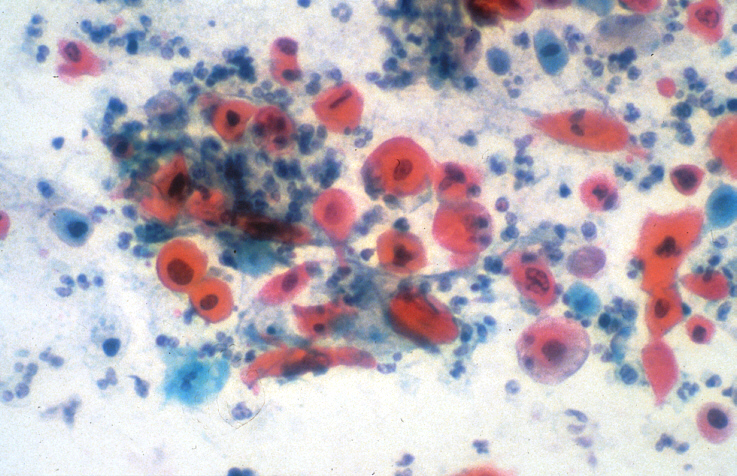 sputum_cytology.jpg (324076 bytes)